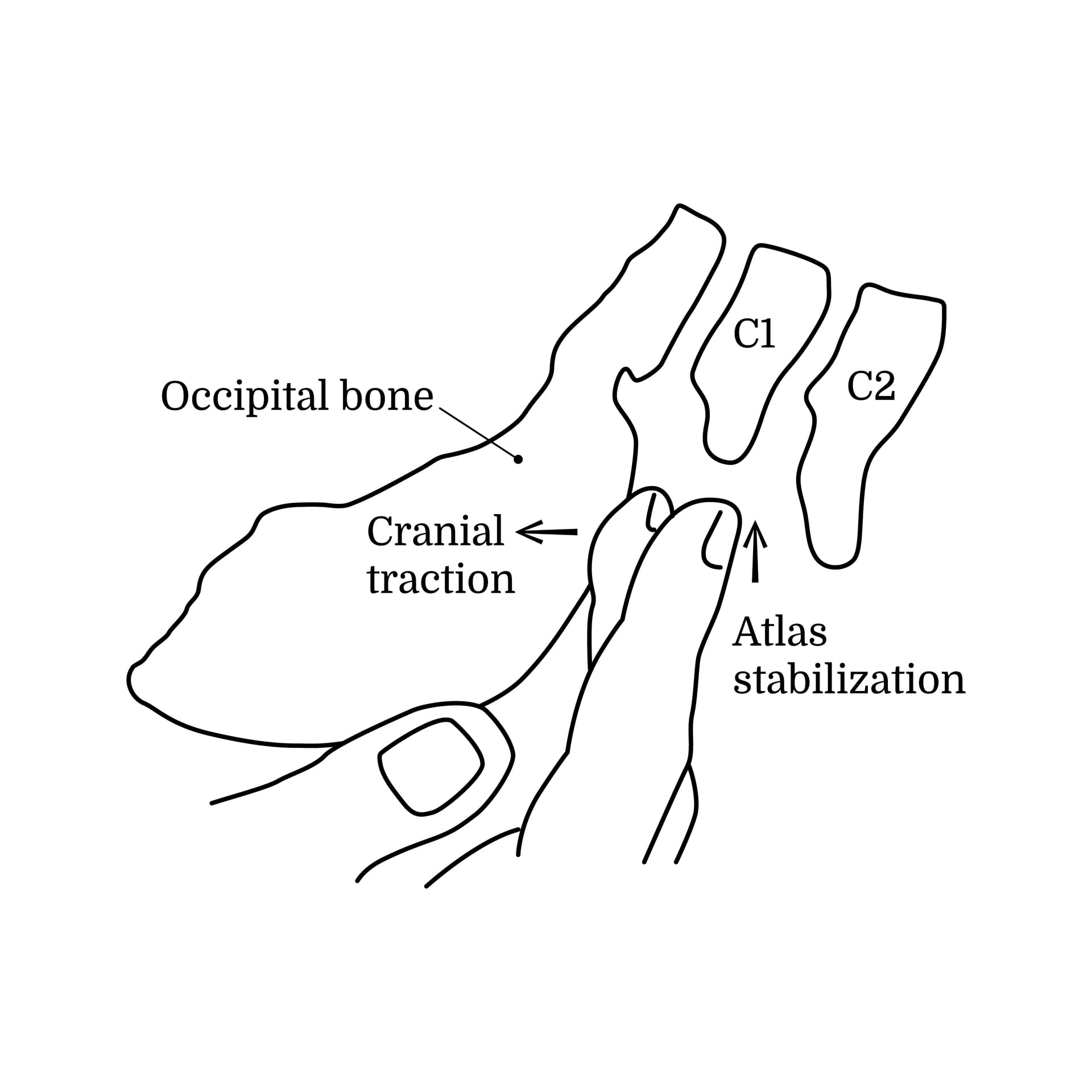 Diagram of a craniosacral hold, applying gentle traction at the occiput while the atlas is stabilised