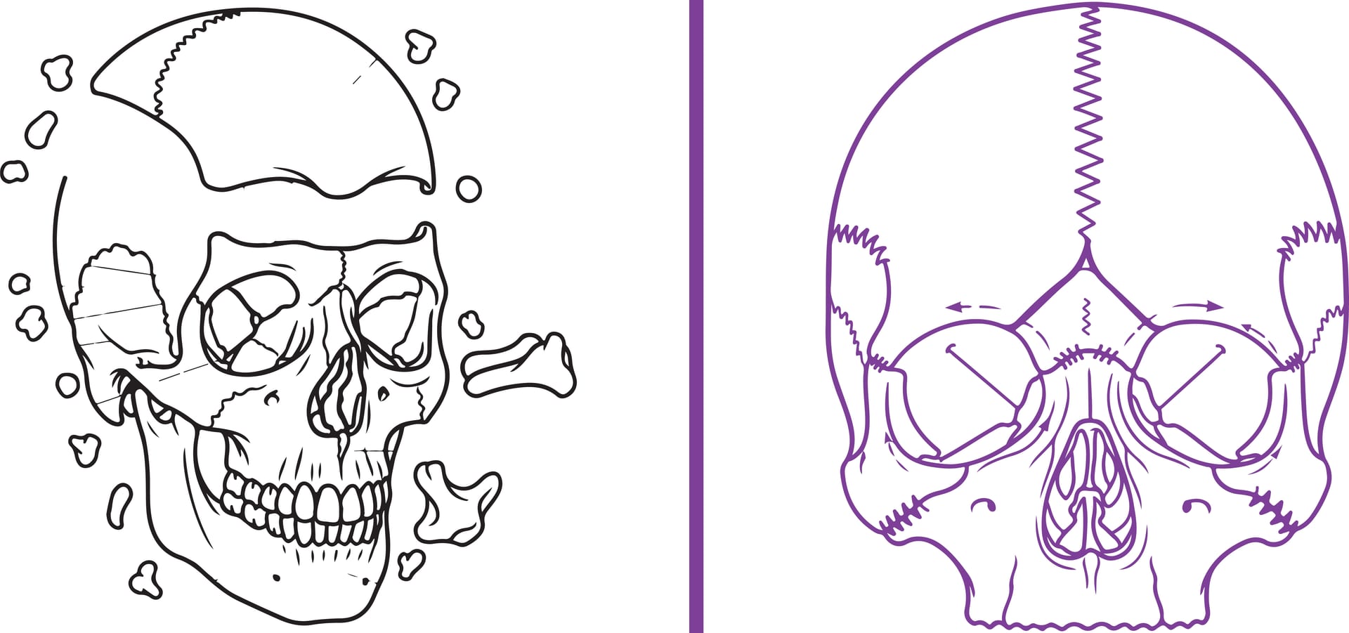 Illustration of the cranial bones and sutures that allow the subtle motion craniosacral therapy works with
